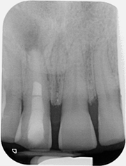 Open apex management - Procedure X-ray